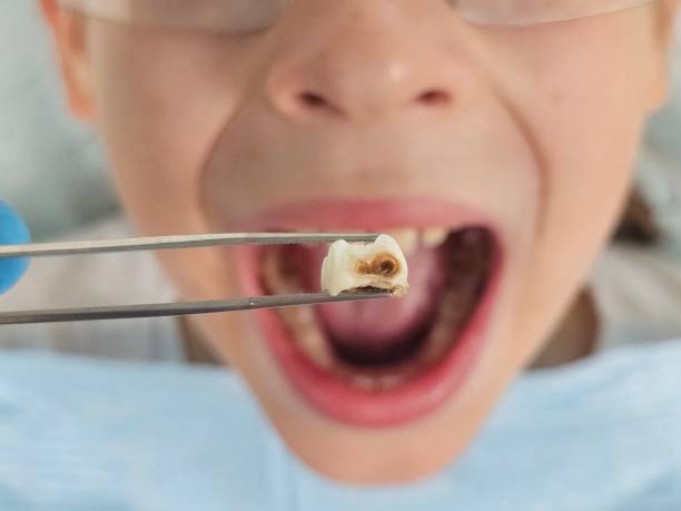 Best Broken or Cracked Tooth Emergency Dentist in Norcross, GA